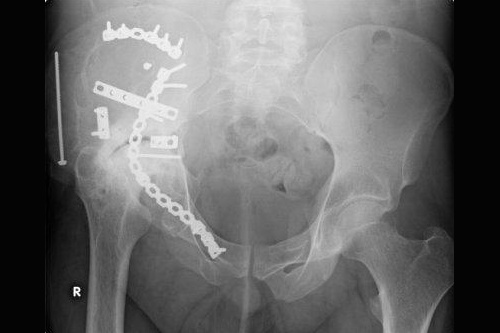Repair of fracture to right acetabulum
